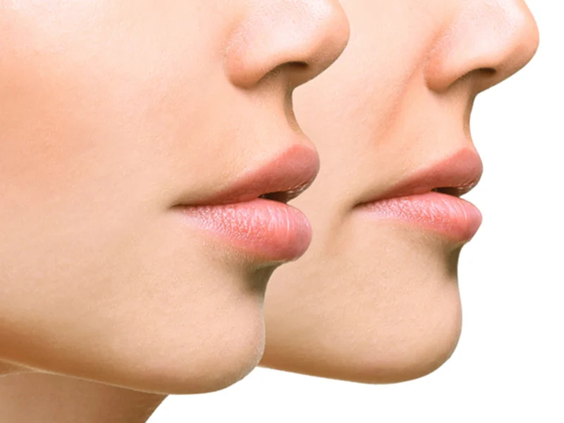 Lip Fillers Ashford Kent