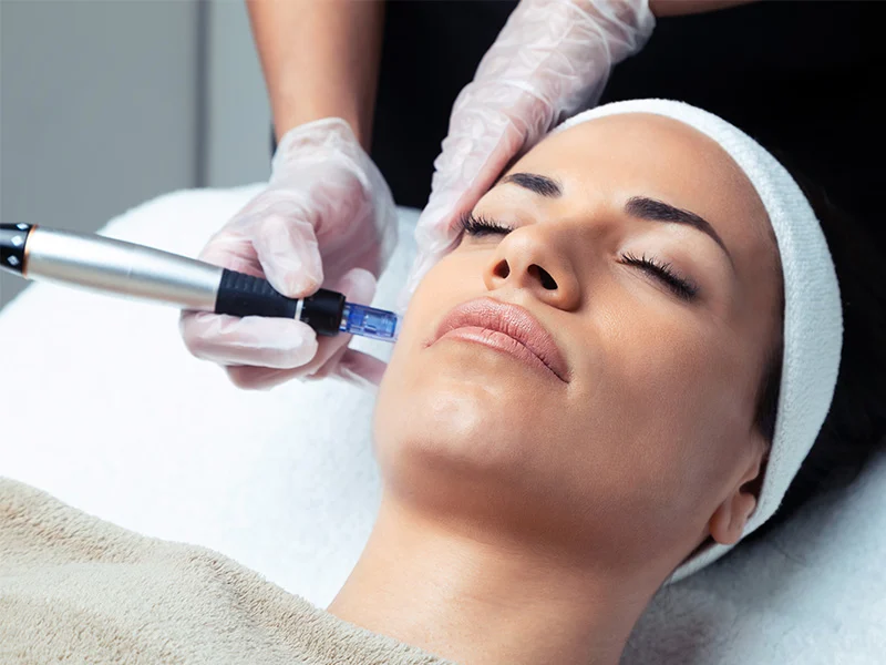 Micro Needling Ashford Kent
