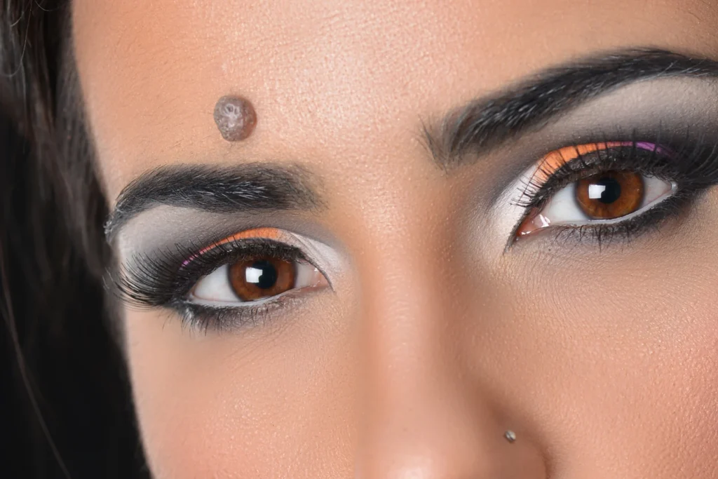 Moles Cysts and Skin Tag Removal Kent